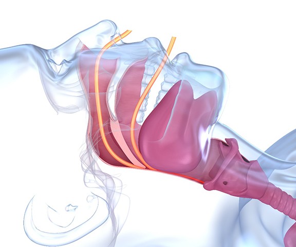 Illustration of airway blockage that occurs during sleep apnea
