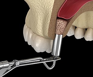  a computer illustration of a sinus lift procedure being conducted