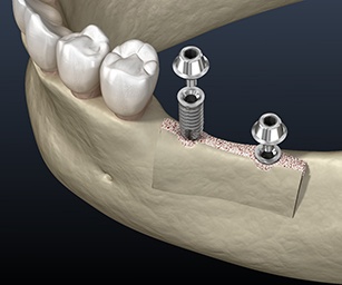 a computer illustration of dental implants being placed in an expanded ridge of a mouth