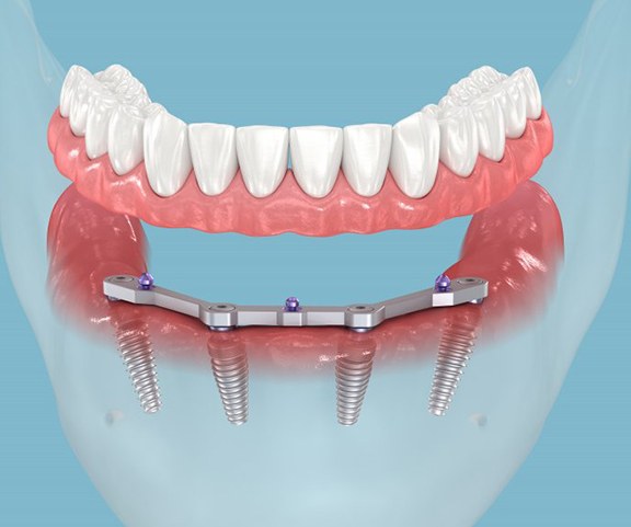a 3D illustration of All-On-4 implants