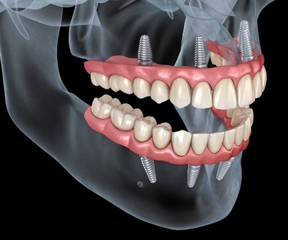 a 3D illustration of All-On-4 implants