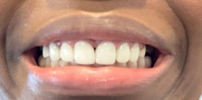 Bright smile after teeth whitening