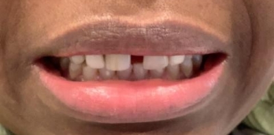 Yellow smile before teeth whitening