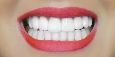 Bright smile after teeth whitening