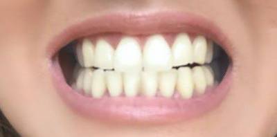 Yellow smile before teeth whitening
