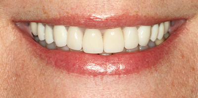 Bright smile after teeth whitening