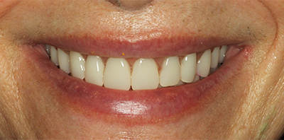 Bright smile after teeth whitening