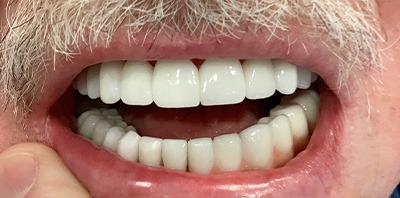 Bright smile after teeth whitening