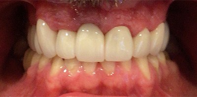 Bright smile after teeth whitening