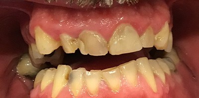 Yellow smile before teeth whitening