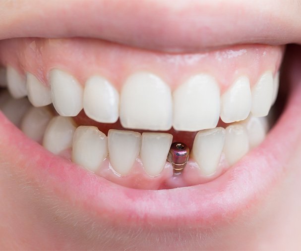 Closeup of a dental implant