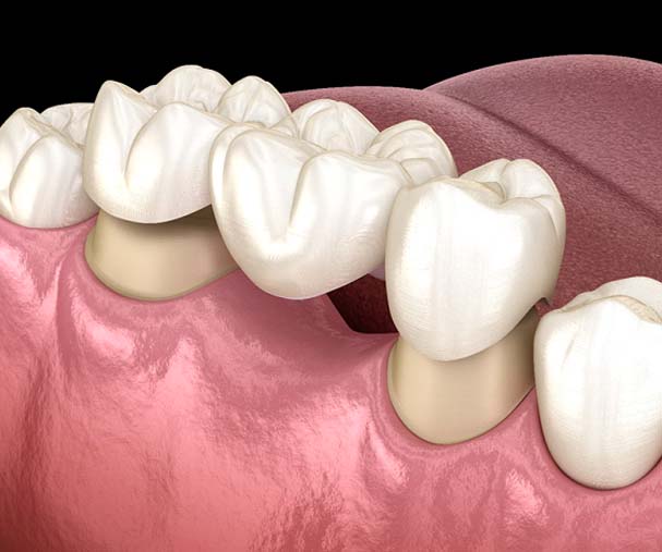 Diagram of a dental bridge in Sparta