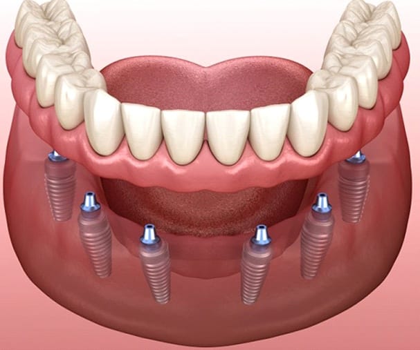 implant-retained dentures
