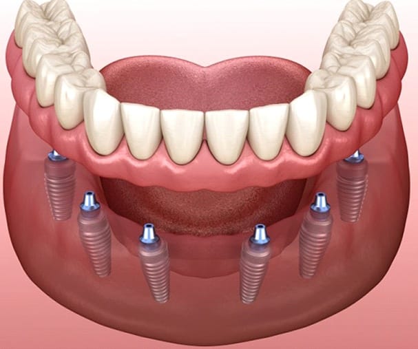 implant-retained dentures 