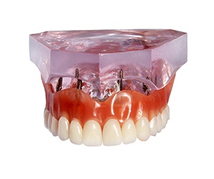 Model of implant dentures in Sparta attached to a model