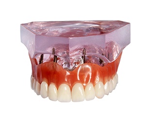 Model of implant dentures in Sparta attached to a model