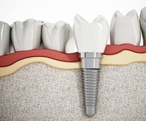 Animation of dental implant in the jaw