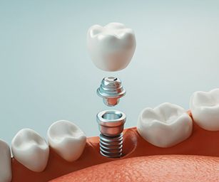 Diagram highlighting components of a dental implant in Sparta