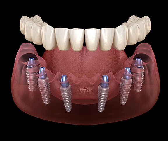 Digital illustration of implant dentures