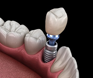 A single tooth dental implant sitting on the lower arch between two healthy teeth in Sparta