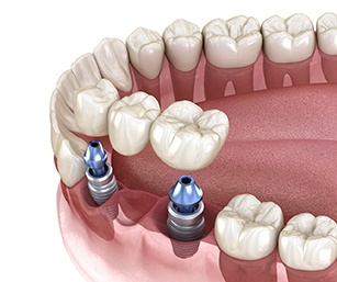 An implant bridge is inserted into the lower arch of the mouth in Sparta