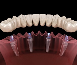 An implant denture secured to four dental implants along the lower arch in Sparta