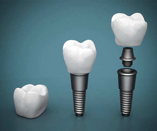 abutment and crown being placed on dental implant post