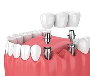 dental bridge supported by two dental implants