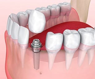 dental implant post, abutment, and crown being placed