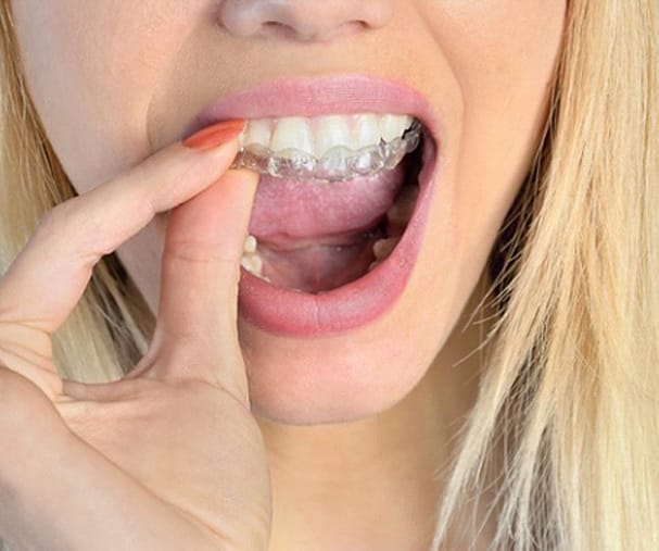 blonde women removing Invisalign in Sparta 