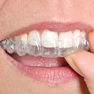 teeth with Invisalign in Sparta