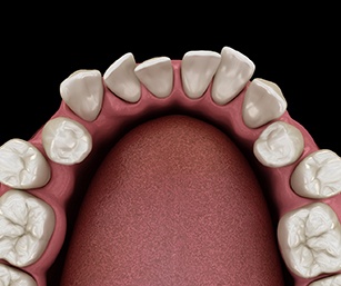3D graphic of crowded teeth