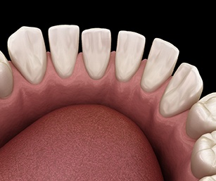 3D graphic of gaps in between the teeth