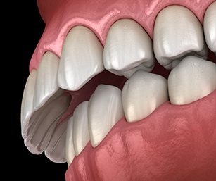 3D graphic of overbite