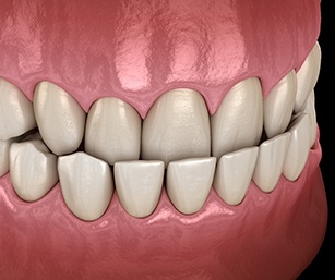 3D graphic of underbite