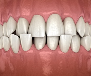 3D graphic of crossbite