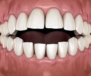 3D graphic of open bite