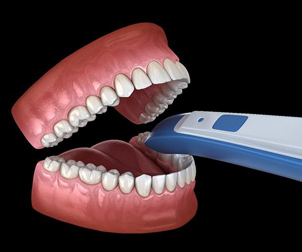 digital scanner taking impressions