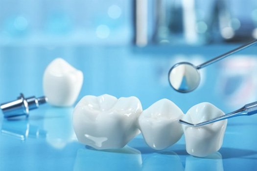 a model of a dental bridge