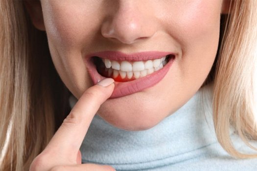 a woman smiling while holding Invisalign aligners