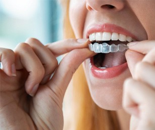 Closeup of woman putting on clear aligner on top teeth