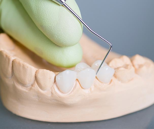 Model smile with fixed bridge restoration