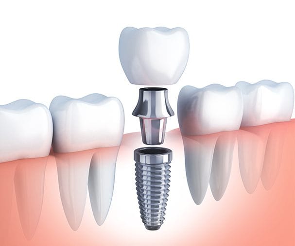 Animation of dental implant placement process