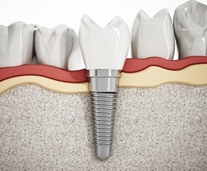 Animated implant supported replacement tooth