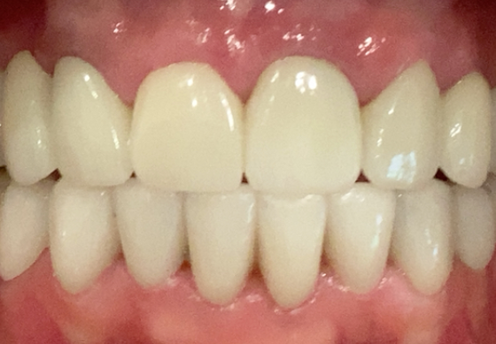 Bright smile after teeth whitening