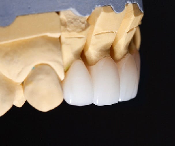 model of a mouth with porcelain veneers attached to it