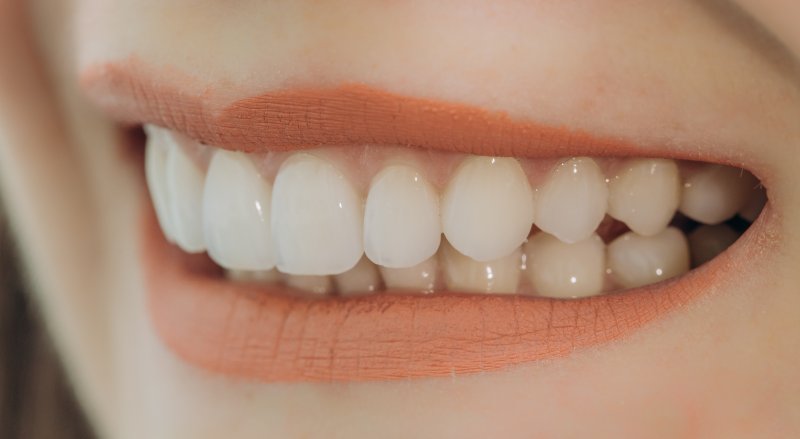 Woman with veneers