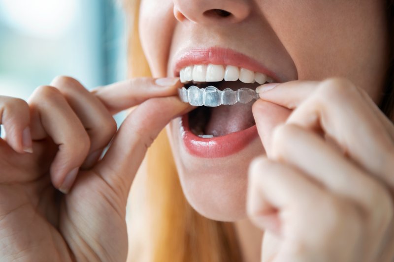 Young woman putting in her Invisalign