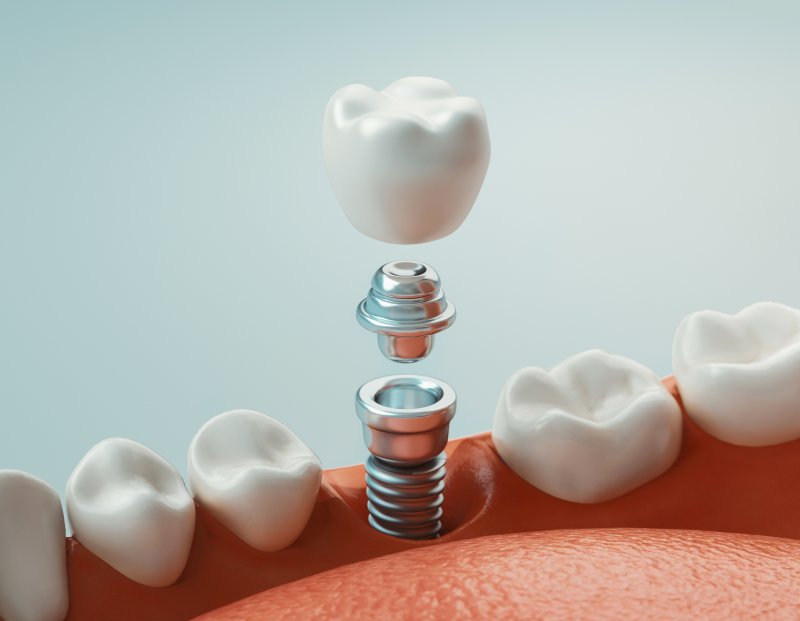 a single dental implant and its part